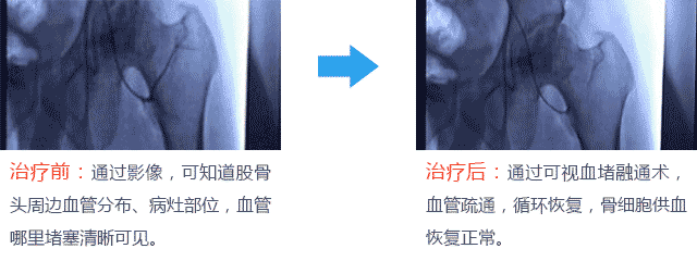 可视血堵融通术血管对比图.gif